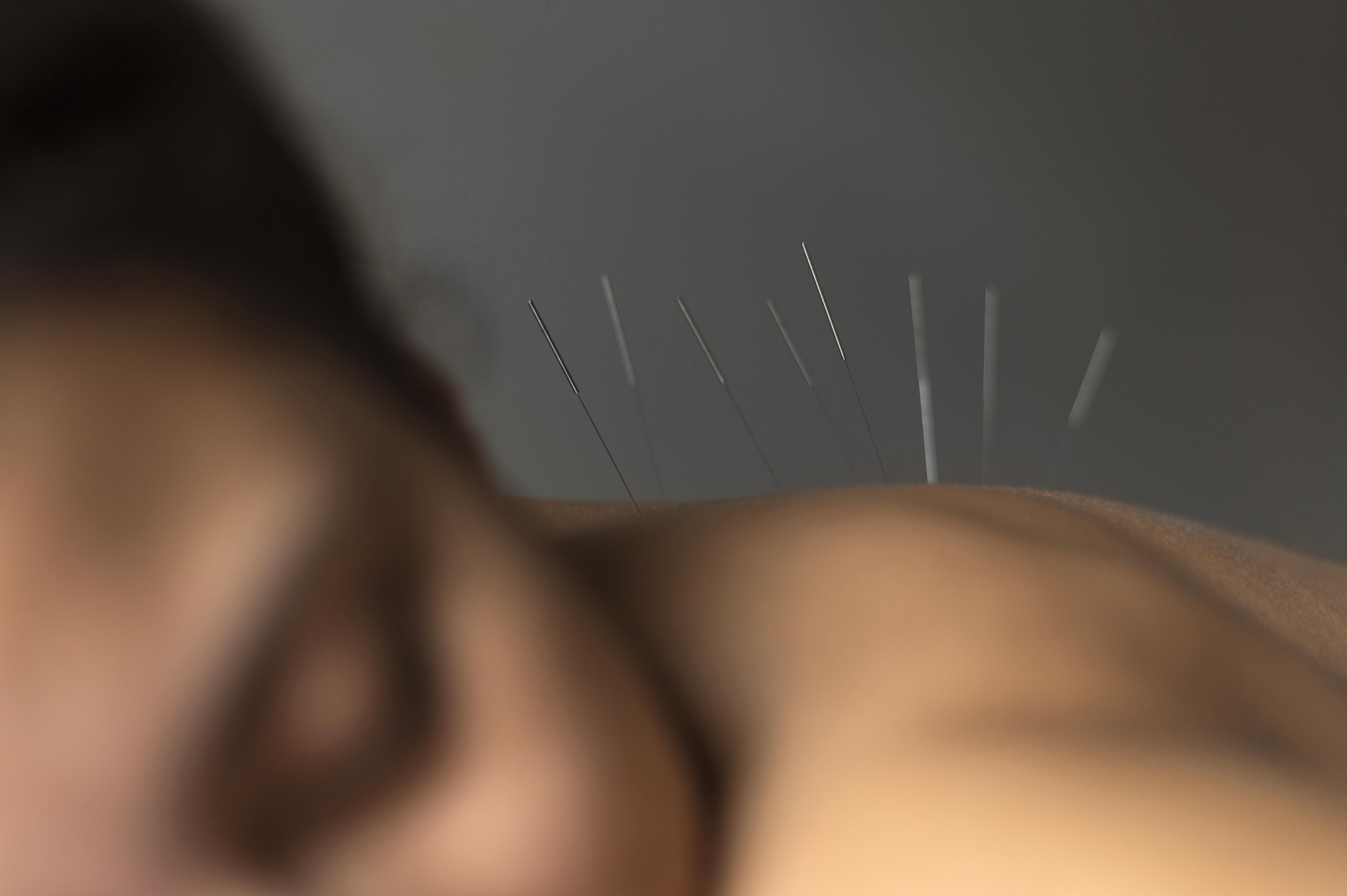 Zufriedene Frau liegt auf dem Bauch mit Akkupunkturnadeln im Rücken. 